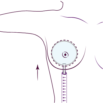 W Clinics Preserve Brustvergroesserung 2-Lipo-Doctors-Lipödem